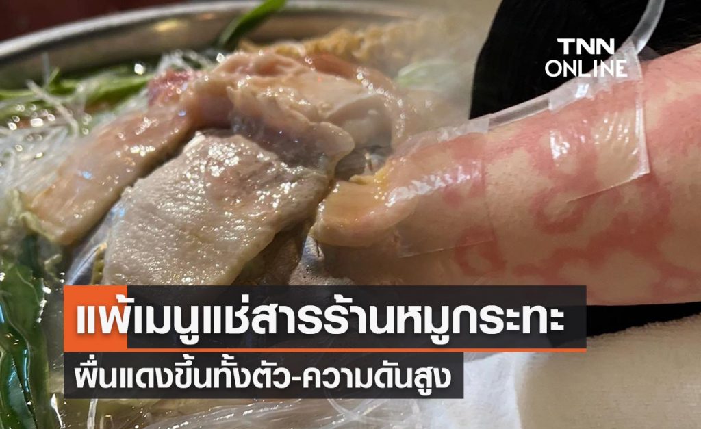 สาวเตือนภัยกิน “เมนูในร้านหมูกระทะ” แพ้สารอย่างหนักผื่นแดงทั้งตัว